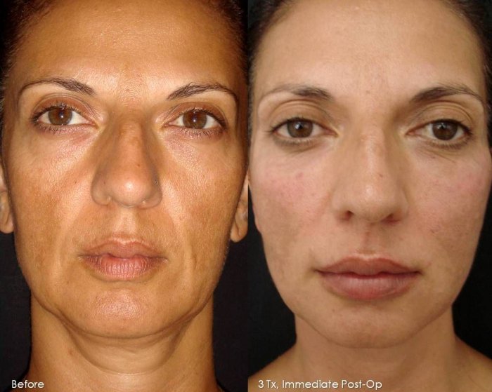 Лицо после плазмолифтинга