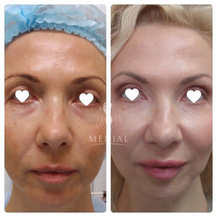 Лицо после плазмолифтинга