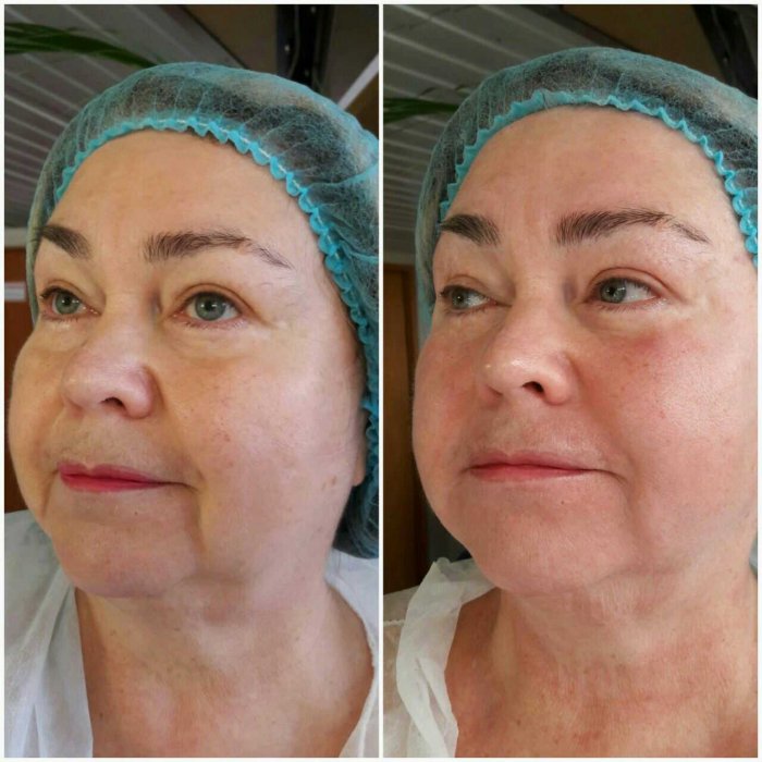 Плазмотерапия лица до и после