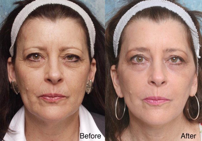 Плазма в косметологии для лица