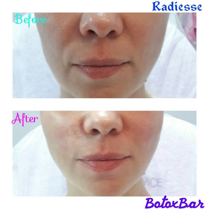 Ботокс от носогубных складок