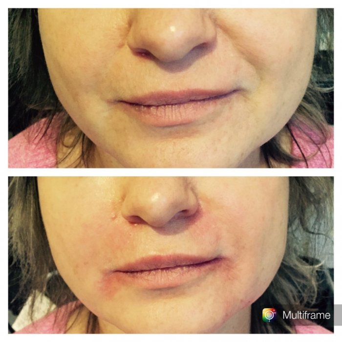 Мезотерапия носогубных складок