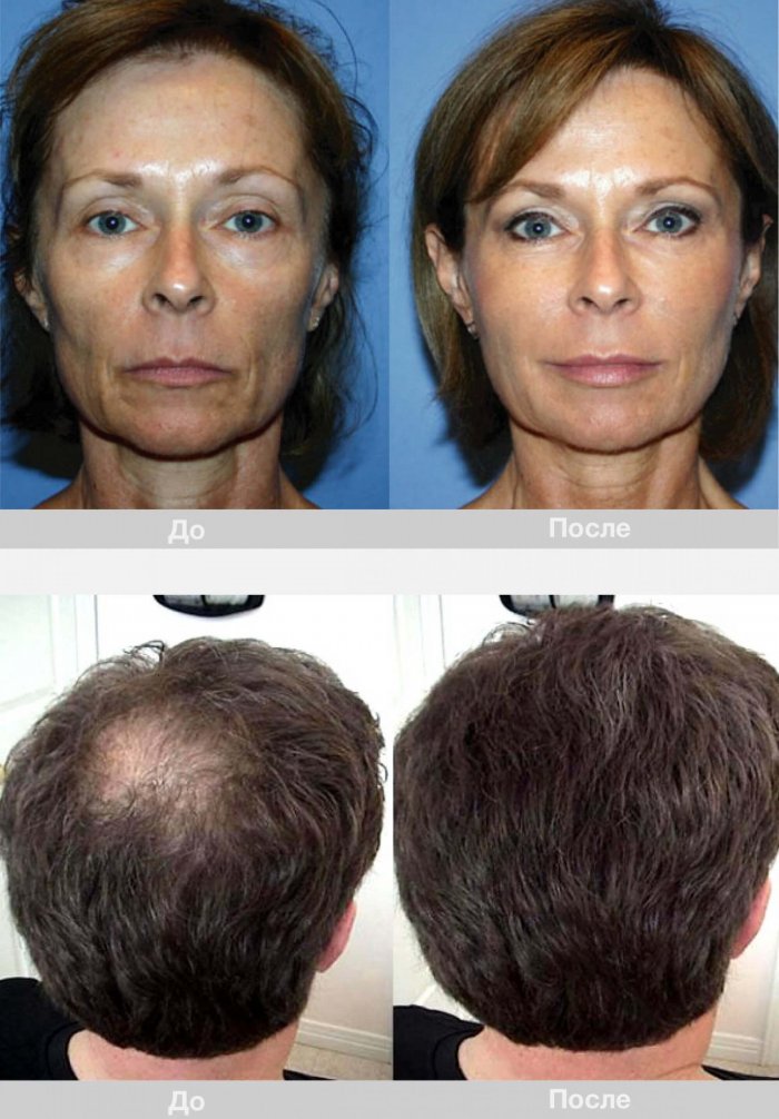 До и после плазмолифтинга лица
