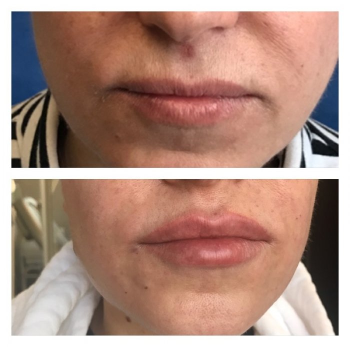 Нити полимолочной кислоты Aptos