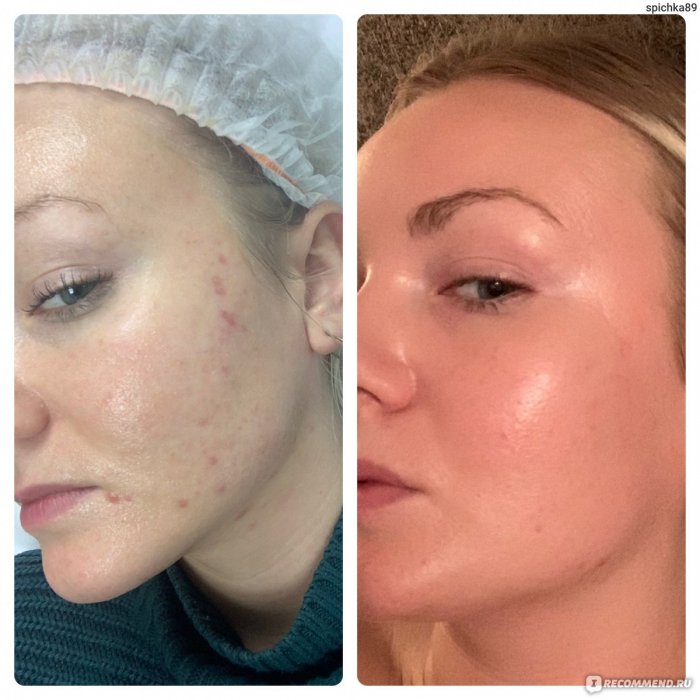Мезотерапия акне до и после