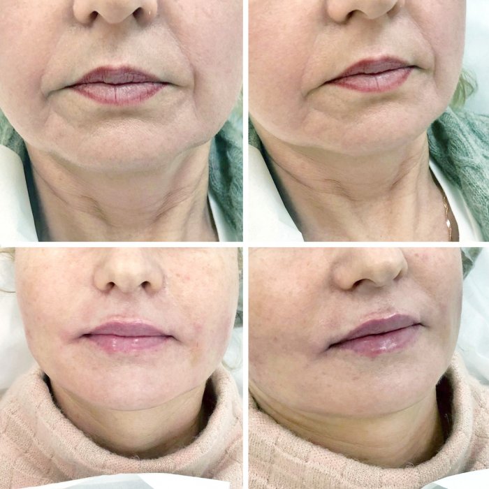 Носогубные складки коррекция