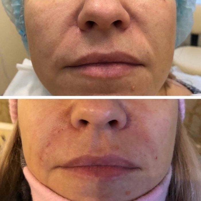 Потемнение носогубных складок