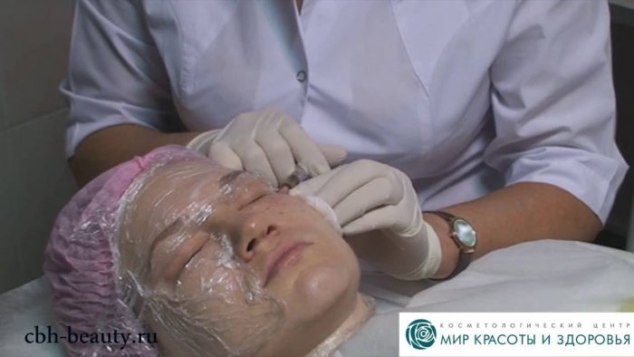 Плазмотерапия лица до и после