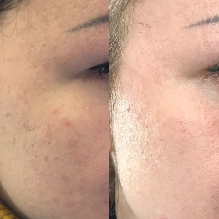 Пилинг постакне до и после