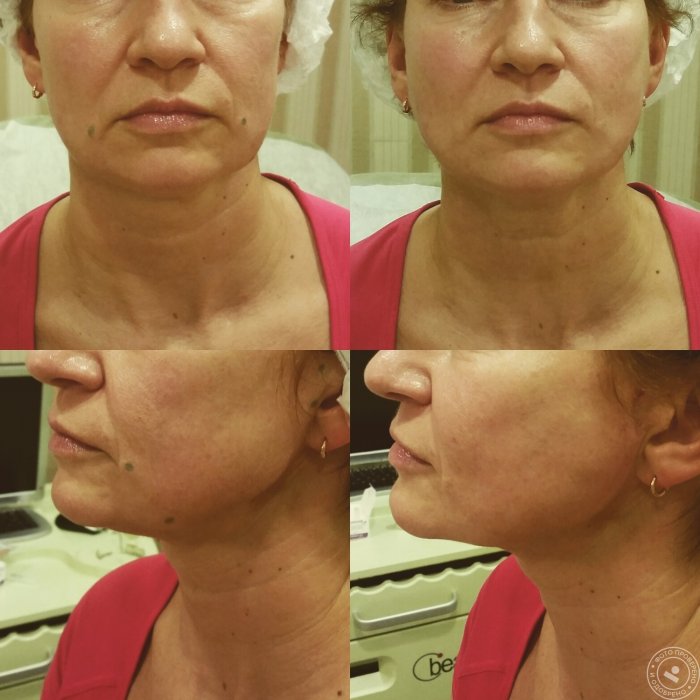 Контурная пластика носогубных складок