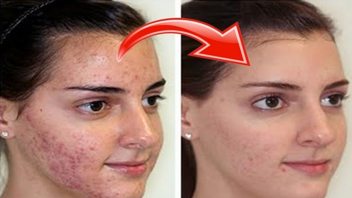 Проблемная кожа до и после