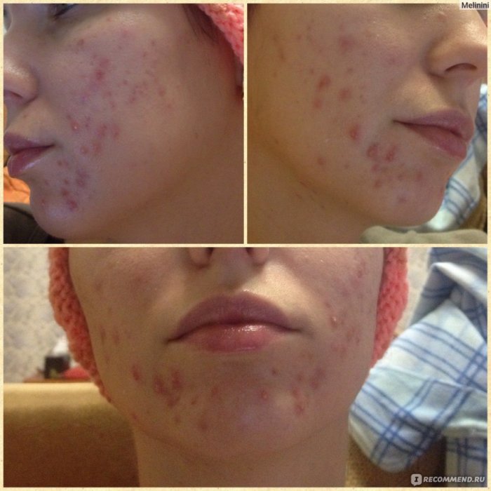 Лазерная шлифовка акне