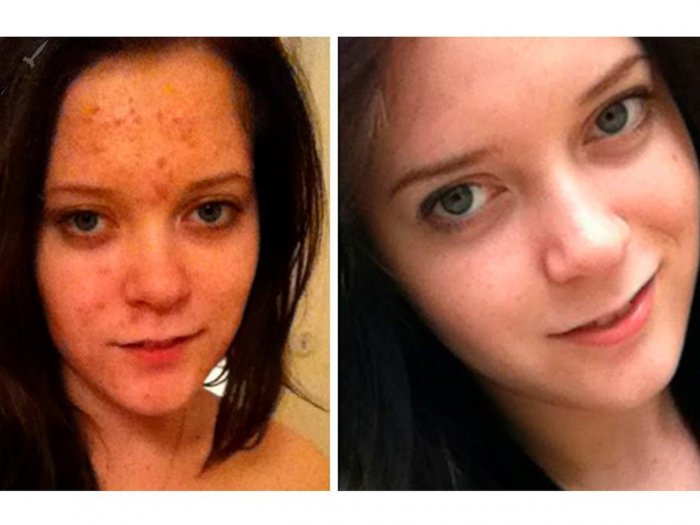 Салициловая кислота от прыщей до и после