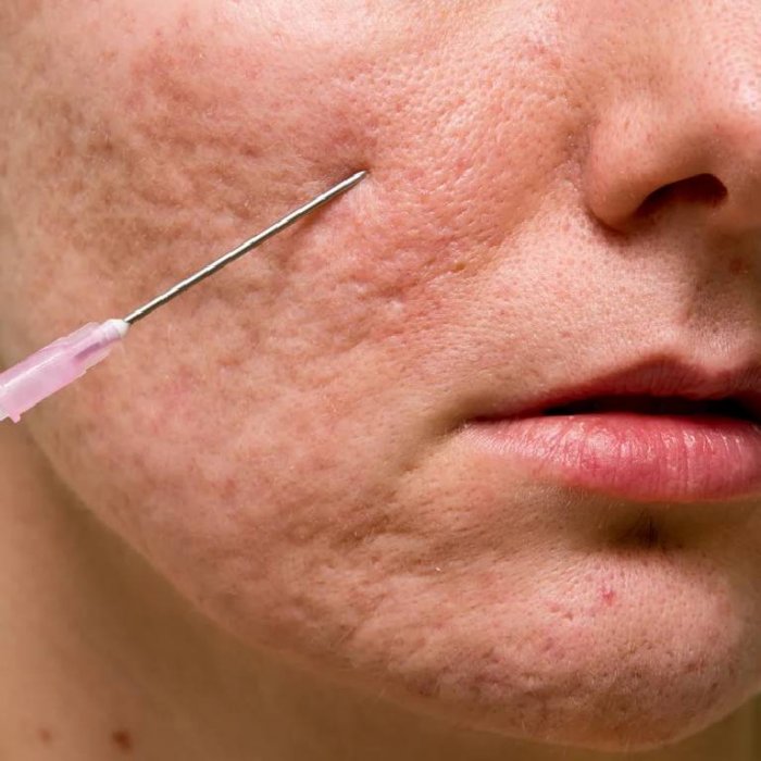 Плазмолифтинг для лица прыщи