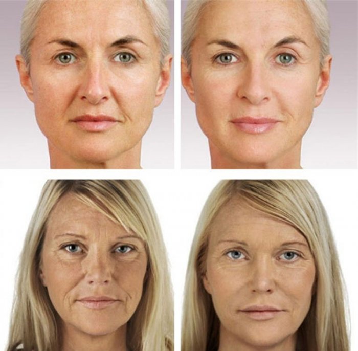 Биоревитализация носогубных складок