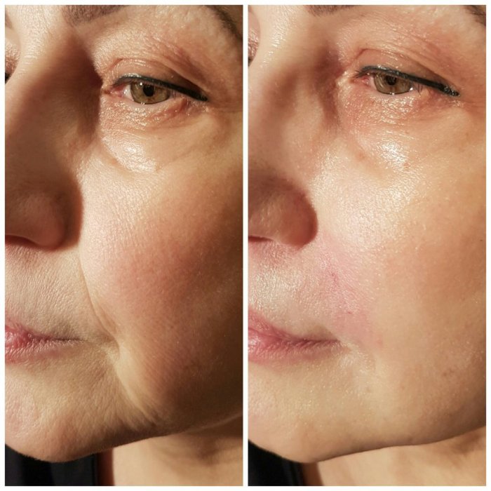 Массаж носогубных складок