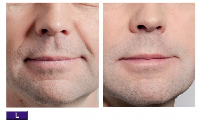 Мезотерапия носогубных складок