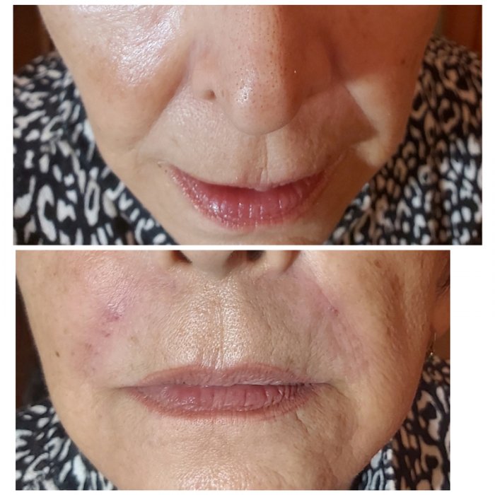 Носогубная складка коррекция