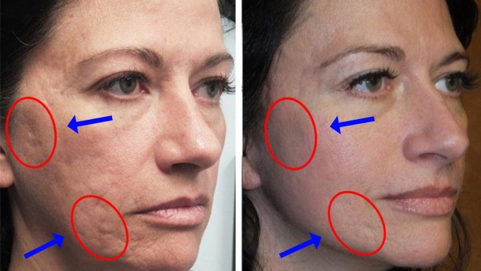 Плазмолифтинг прыщи до и после