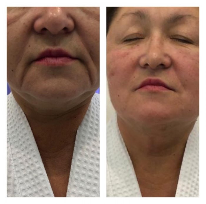 Заполнение носогубных складок филлерами