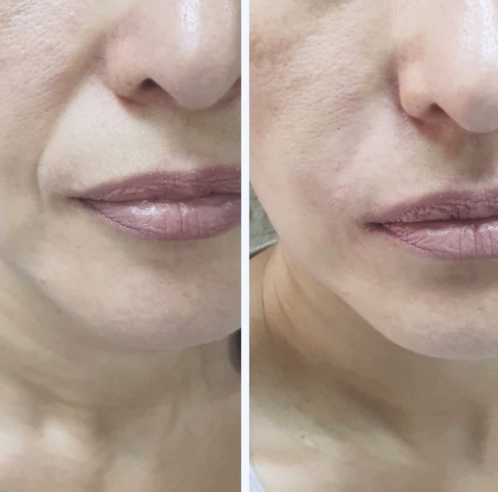 Биоармирование Aptos нитевой лифтинг