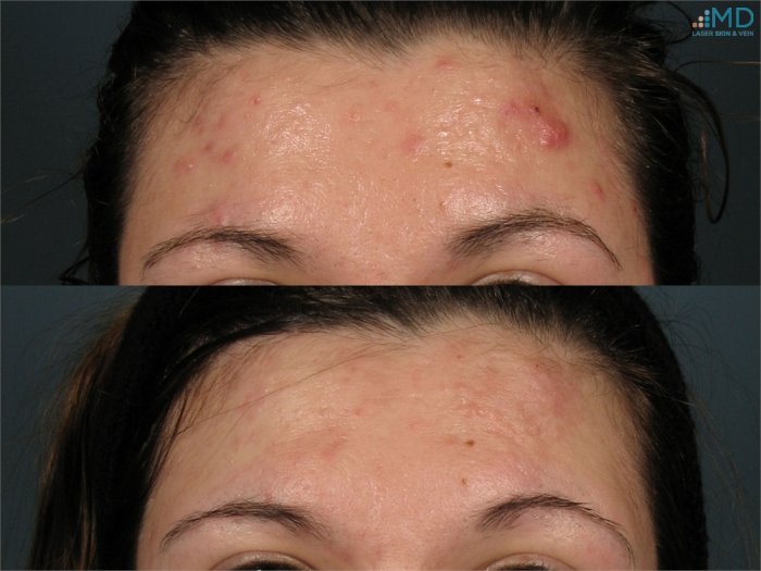 Плазмолифтинг акне до после