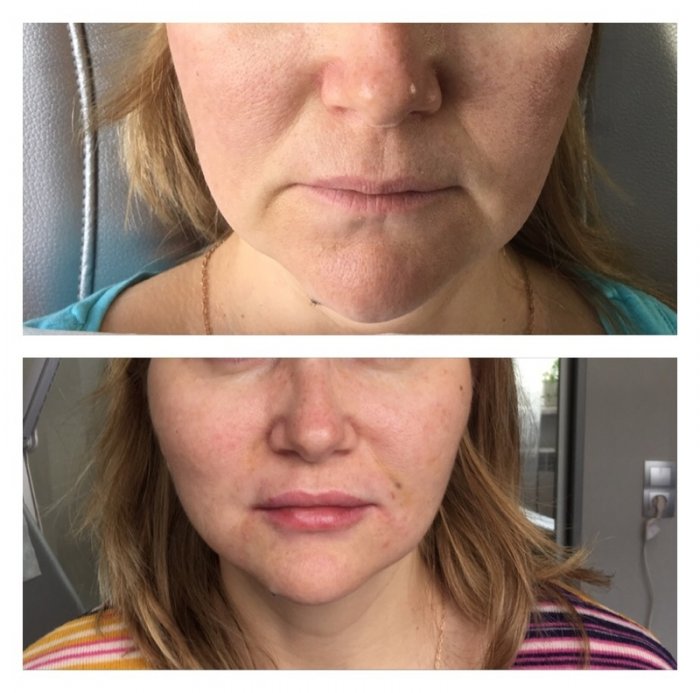 Пластика носогубных складок