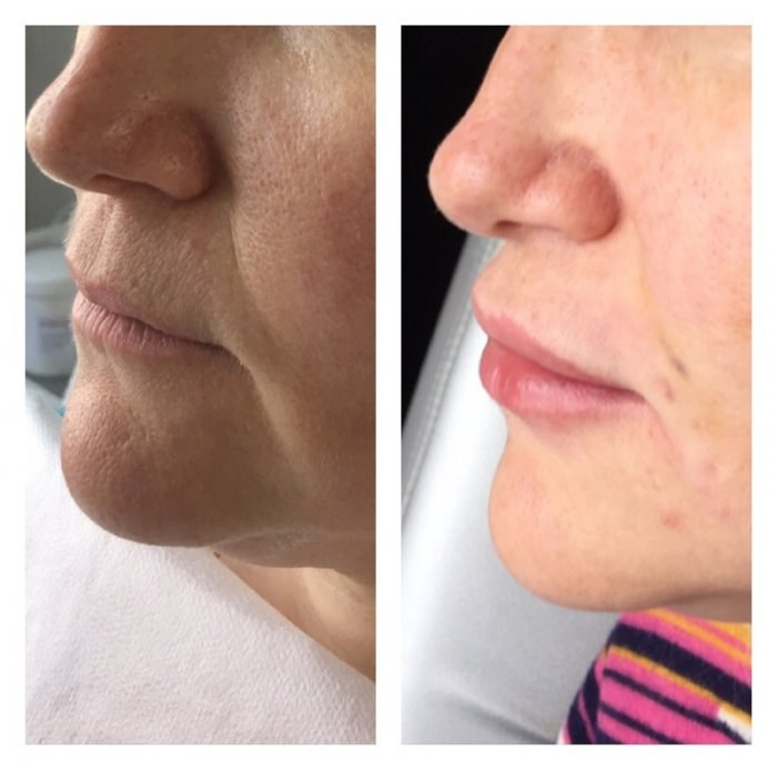 Филеры в носогубные складки