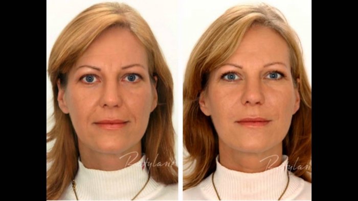 Мезотерапия носогубных складок