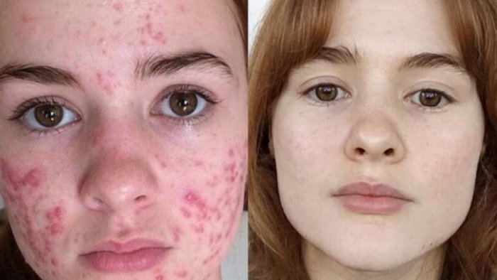 Плазмолифтинг и комедоны