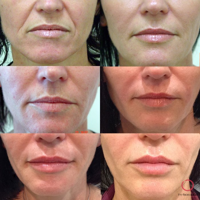 Гиалуронка в носогубные складки