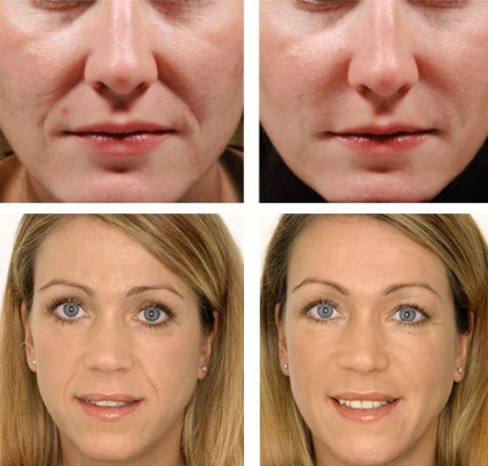 Носогубные складки биоревитализация