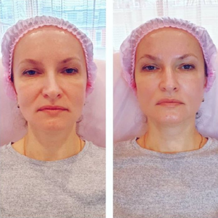 Нитевой лифтинг носогубных складок