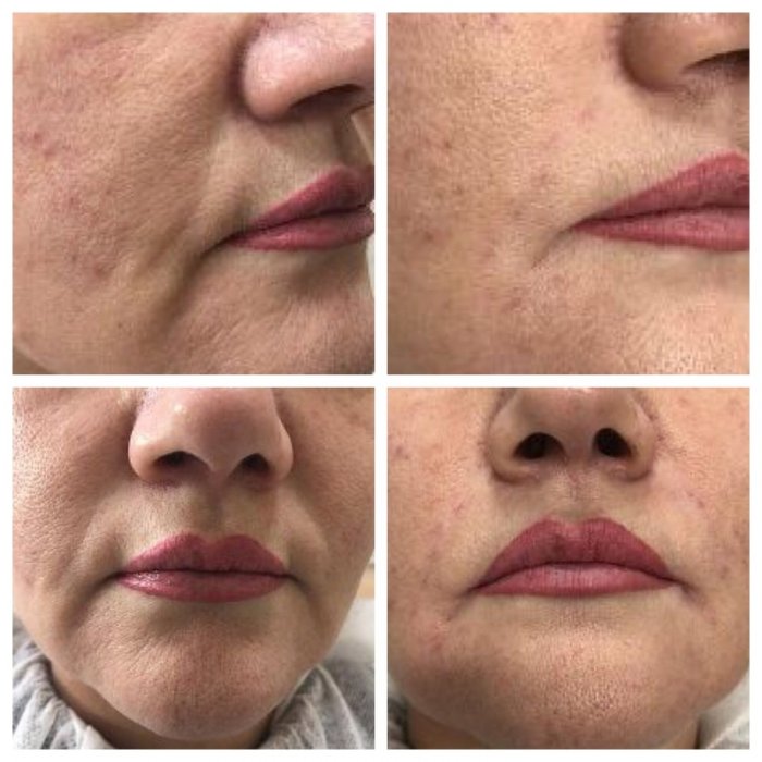 Коррекция носогубных складок