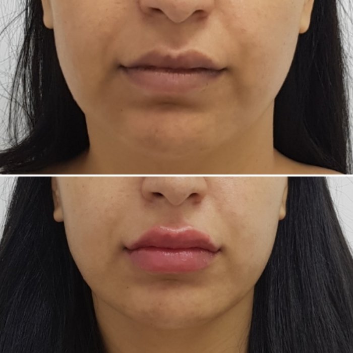 Носогубные складки биоревитализация