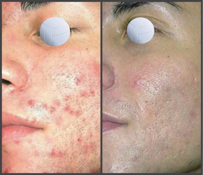 Пилинг хлористым кальцием