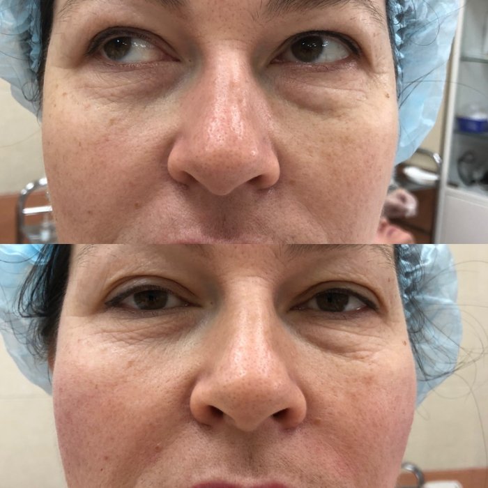 Массаж для коррекции носогубных складок