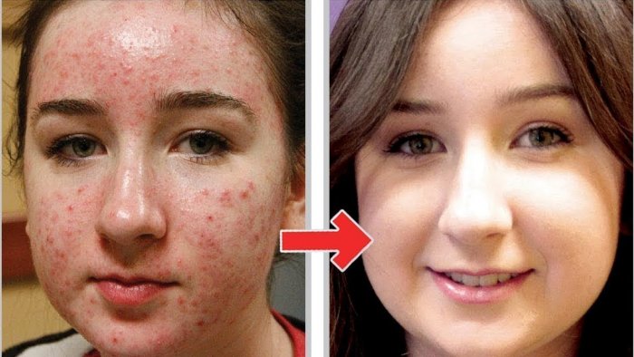 Салициловая кислота JN hjcnfryt