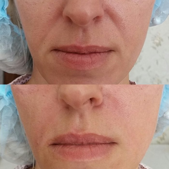 Разглаживание носогубных складок