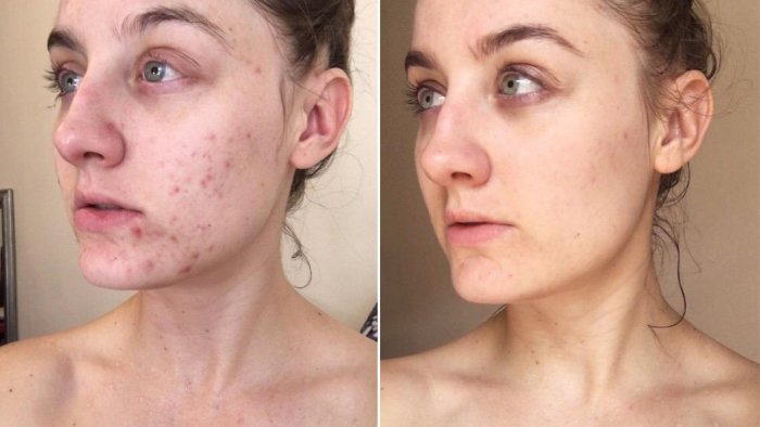 Плазмолифтинг для лица постакне