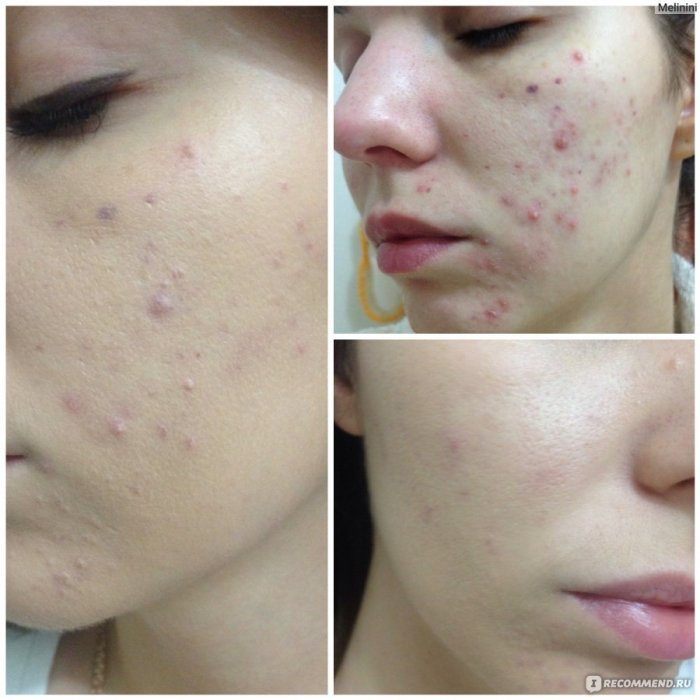 Плазмолифтинг для лица постакне