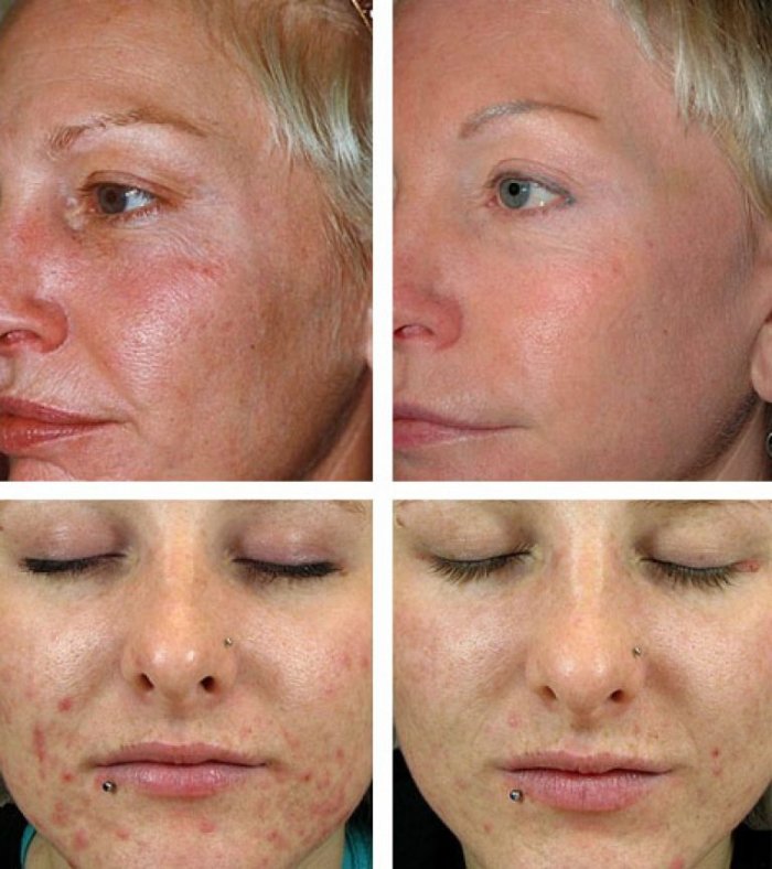 Лицо сразу после плазмолифтинга