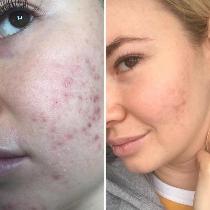 Плазмолифтинг при прыщах