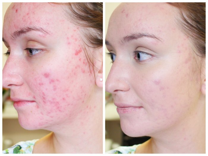 Плазмолифтинг акне до после
