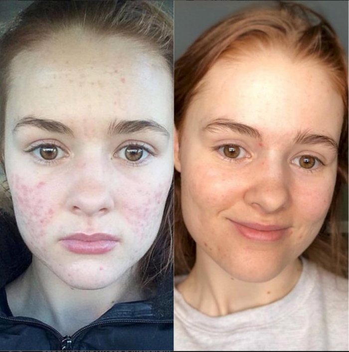 Плазмолифтинг акне до после