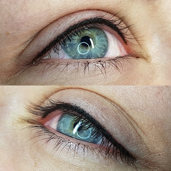 ПМ межресничного пространства