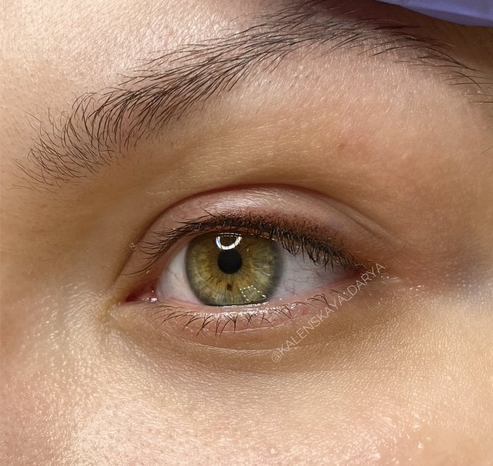 Межресничка пожилой женщине