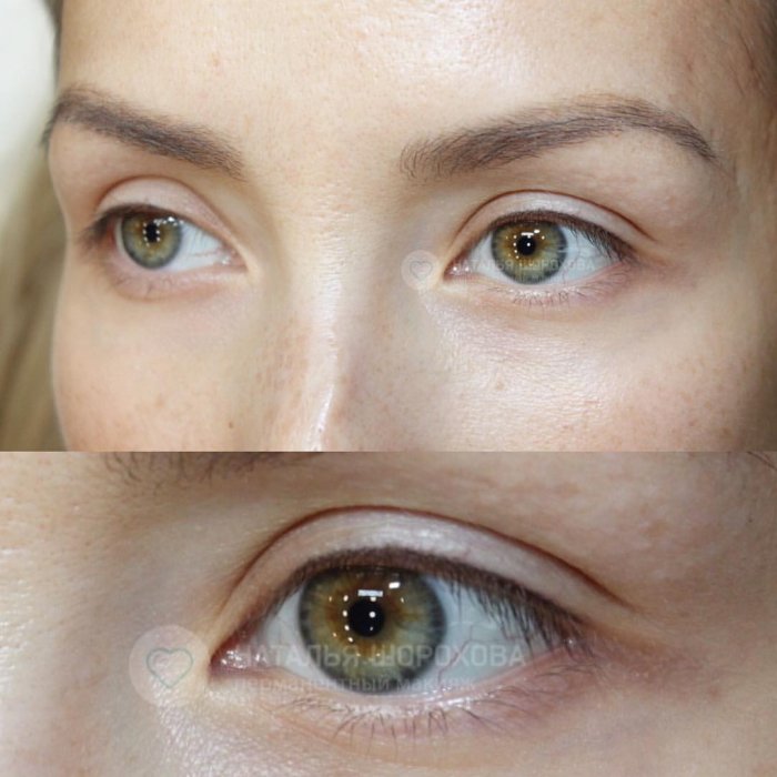Заживший татуаж межресничного пространства