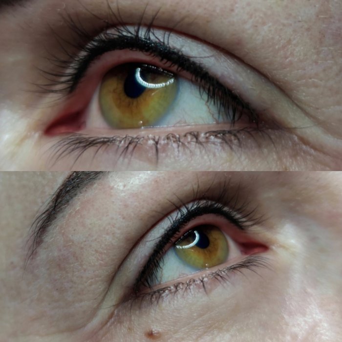 Неудачная межресничка