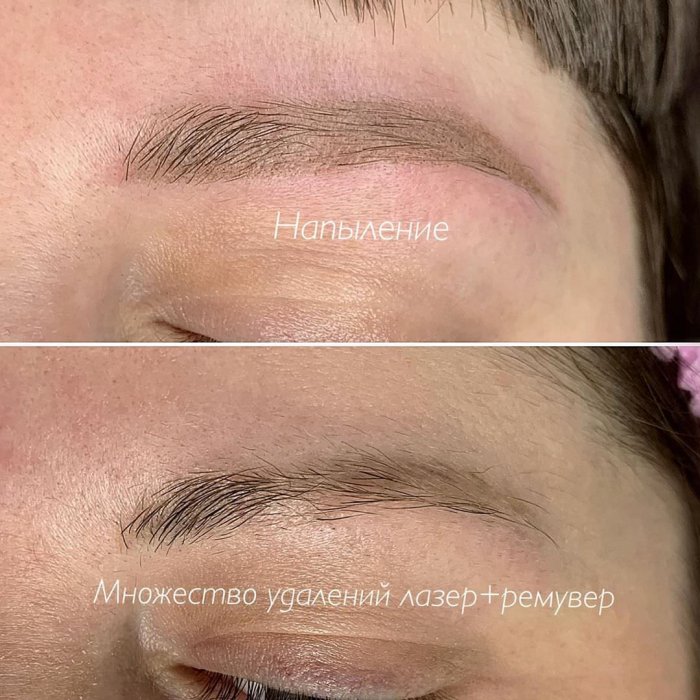 Жёлтый остаток татуажа